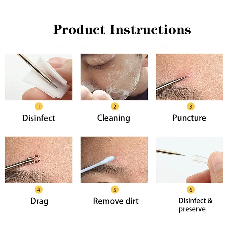 5-in-1 Blackhead Extractor: Squeeze Acne Needles for Nose & Face